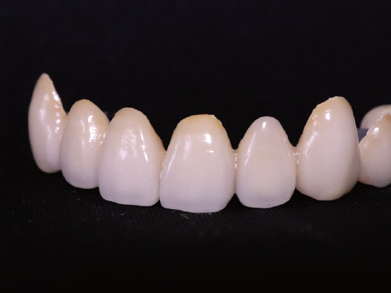 歯冠修復物 「歯冠修復物」には、セラミックスやプラスチックでつくる白い歯や、 金属でつくる被せ物の歯があります。 本物の歯とそっくりにつくることができ、 口元に悩みを抱えた患者さんの笑顔を回復できます。