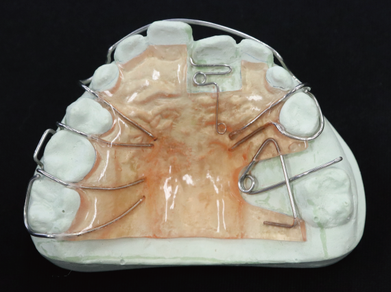 矯正装置 「矯正装置」は、ワイヤーの力を使って 歯を少しずつ動かす装置やネジの力で顎を 広げる装置などがあります。 歯並びや咬み合わせを治すことで機能を回復すると共に、 口元も美しくなります。