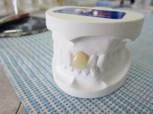 埼玉歯科技工士専門学校ブログ白い差し歯イメージ画像1